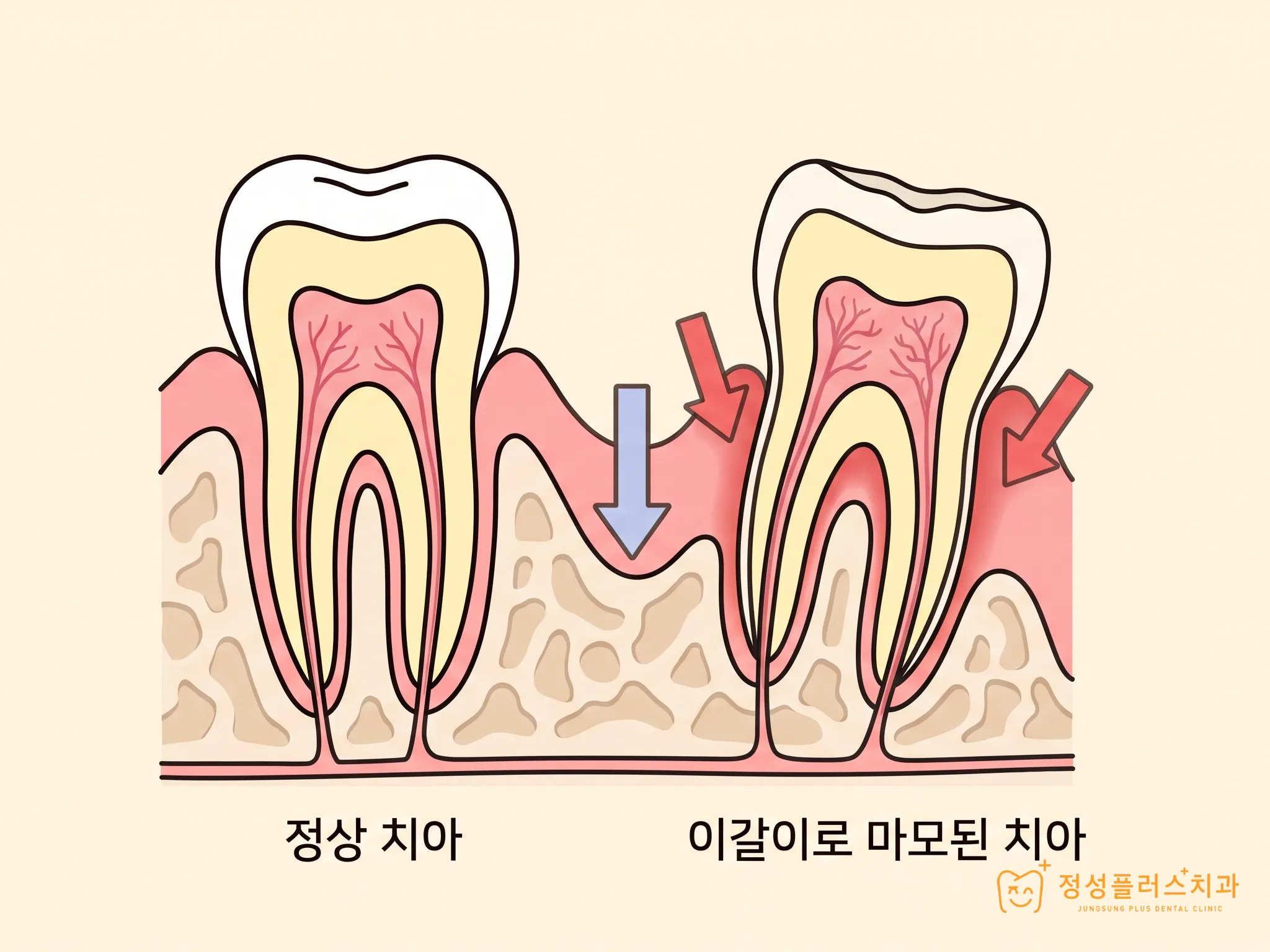 부천 고강동 치과 치아 사이에 자꾸 음식이 끼는 이유