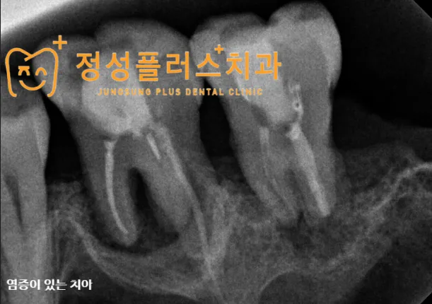 신월동 치과 잇몸에서 고름이 나온다면, 그냥 두면 안 되는 이유