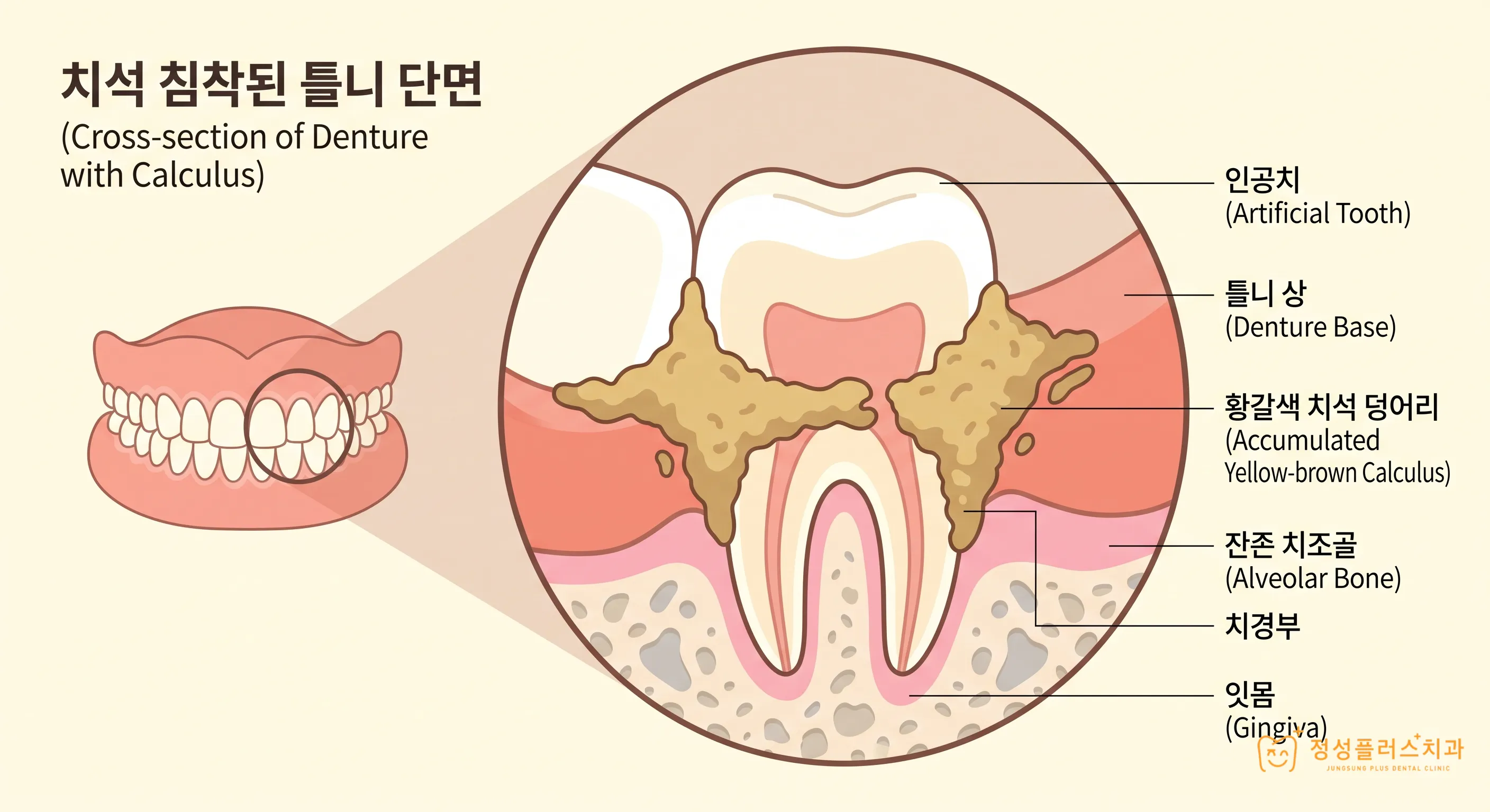 원종동 틀니, 치약으로 닦아도 되나요? 치과에서 말리는 이유