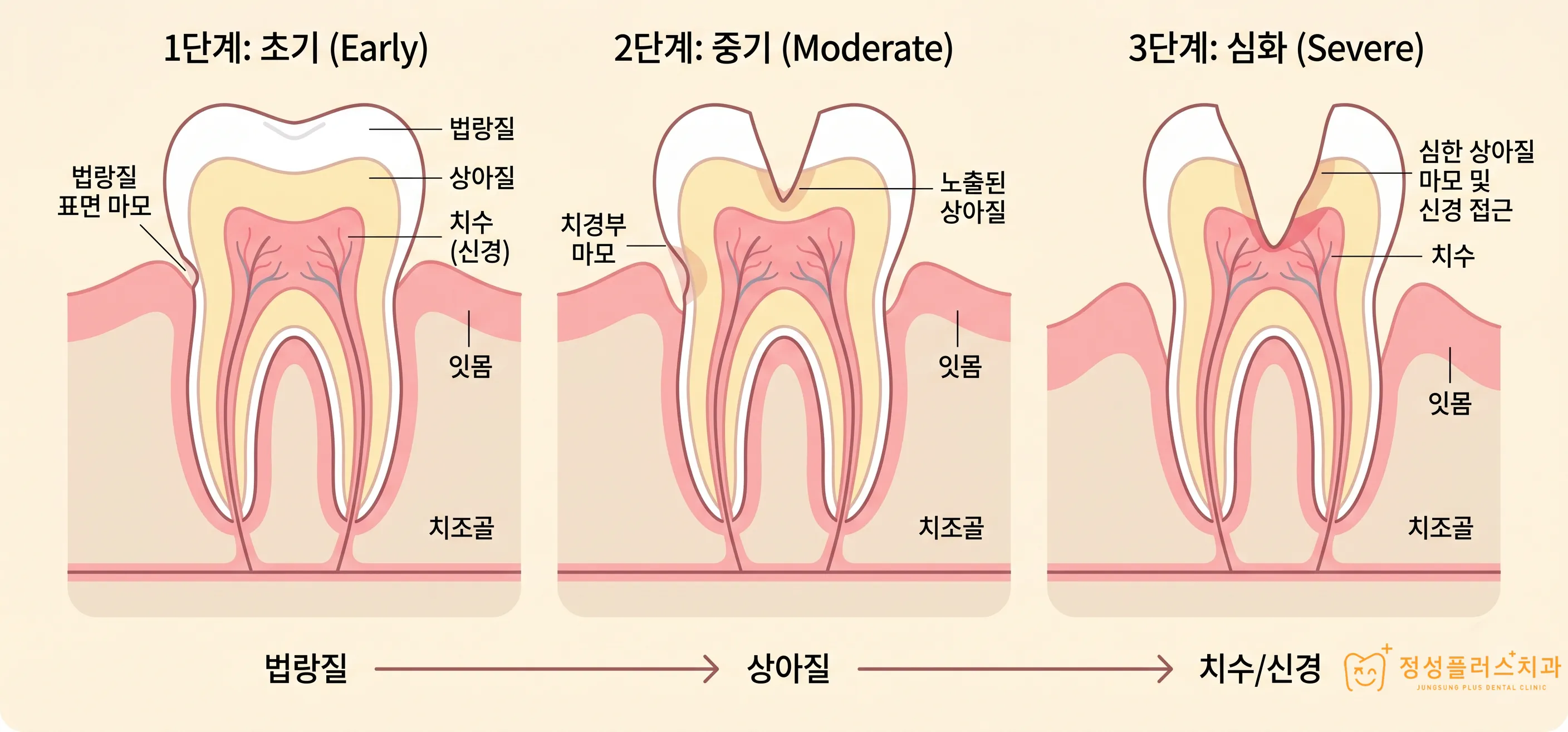 화곡 치과 양치할 때 찬물이 닿으면 소름 끼치게 시린 이유가 있습니다.