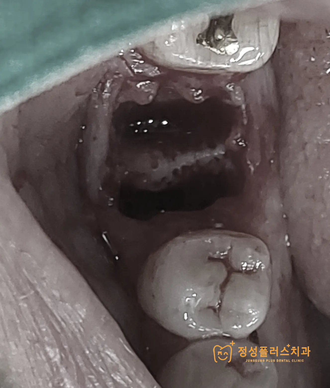 화곡 치과, 신경치료 후 다시 아프다면? 통증 재발 원인과 해결법