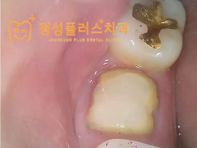 화곡 치과, 신경치료 후 다시 아프다면? 통증 재발 원인과 해결법
